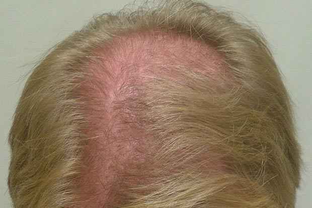É possível reverter a queda de cabelo na maioria dos casos. Foto:Evolution Hair Centers/Flickr/Reprodução() É possível reverter a queda de cabelo na maioria dos casos. Foto:Evolution Hair Centers/Flickr/Reprodução/