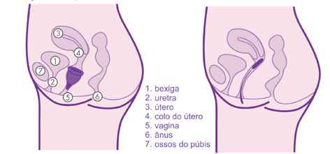 Menos invasivo que o absorvente interno, o copinho é alternativa para quem não quer se privar de atividades físicas e banhos de mar. Arte: Inciclo/Divulgação