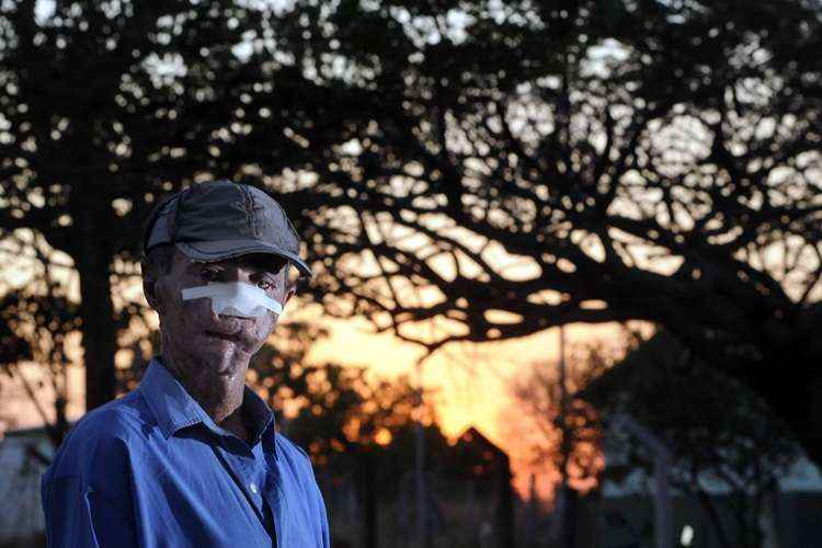  José Cláudio Machado tem xeroderma pigmentoso, uma doença genética que atinge moradores de povoado de Faina. Foto: Ronaldo de Oliveira/CB/D.A Press