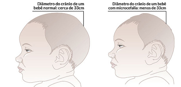A microcefalia é uma malformação congênita, em que o cérebro não se desenvolve de maneira adequada. Arte: EM / D.A Press