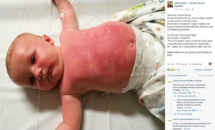 Jessie postou uma foto do bebê com manchas avermelhadas no tórax, nos braços e no rosto. Foto: Cancer Council Australia/Facebook/ Jessie postou uma foto do bebê com manchas avermelhadas no tórax, nos braços e no rosto. Foto: Cancer Council Australia/Facebook/