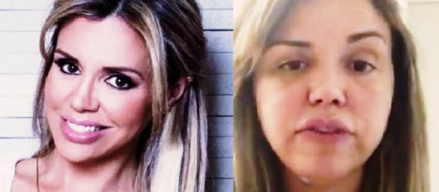 Modelo compartilhou imagens da doença nas redes sociais. Foto: Instagram/Reprodução/