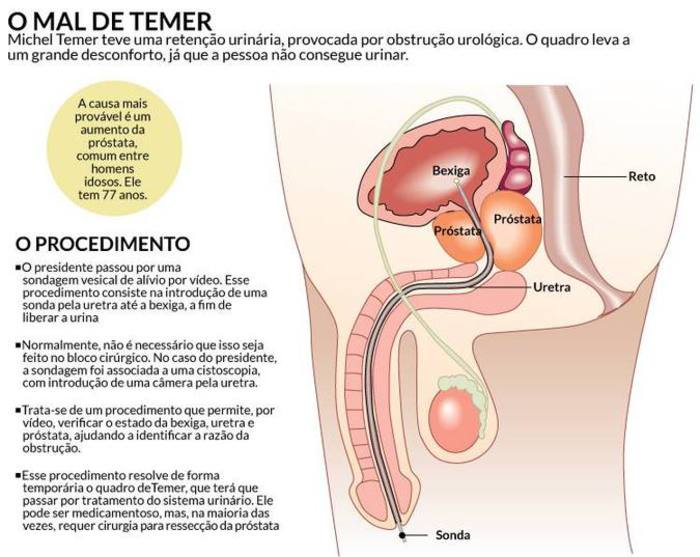 A causa mais comum é uma condição conhecida como hiperplasia da próstata benigna. Foto: Arte/AE/