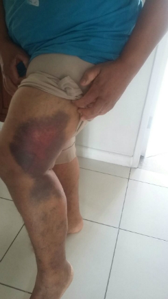 Placa de aço caiu em cliente no Pão de Açúcar