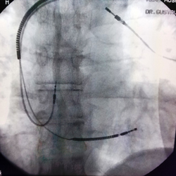 Procedimento menos invasivo feito por uma pequena incisão possibilita a alta hospitalar no mesmo dia. Foto: Biomedical/Divulgação