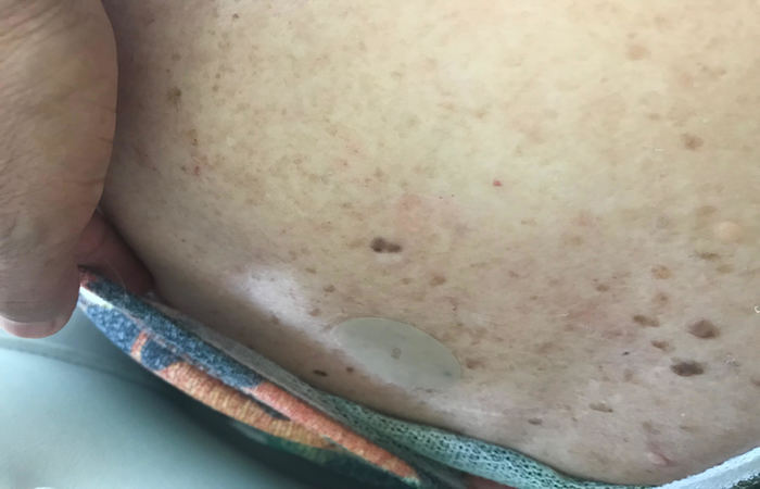 Adesivo é colado nas costas do paciente e precisa ser trocado a cada 24 horas. Uma caixa custa em média R$ 500, com desconto do laboratório. Foto: Ana Paula Neiva/DP/