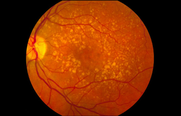 Foto: National Eye Institute of the NIH / Creative Commons/ Foto: National Eye Institute of the NIH / Creative Commons/