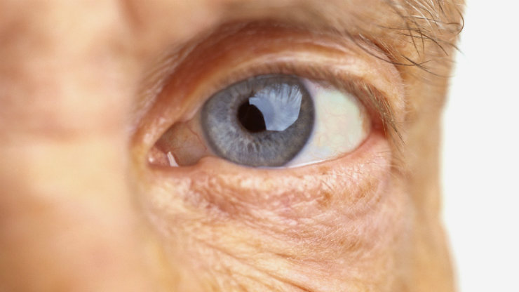 Catarata provoca sintomas como visão turva e alteração na percepção das cores. Foto: Reprodução da internet/