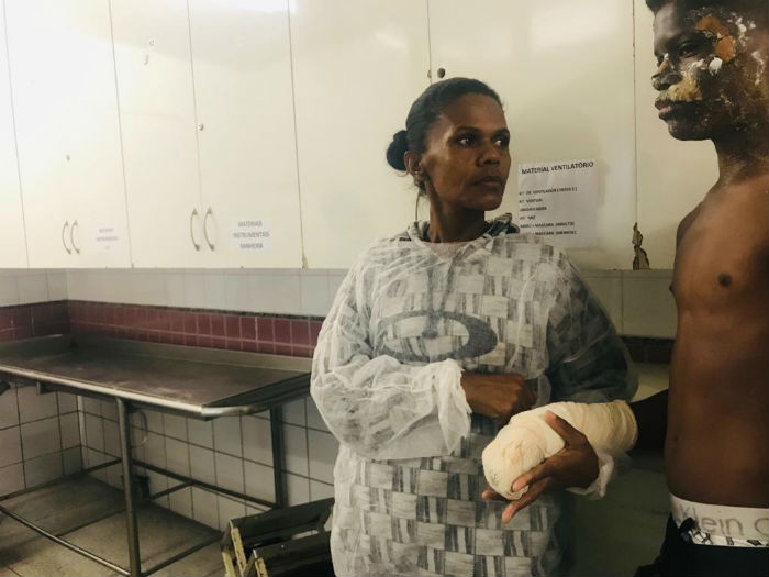 Bruno, 12 anos, feriu o rosto e uma das mãos ao acender a pólvora de uma bomba achada na rua. Foto: Marcionila Teixeira/DP