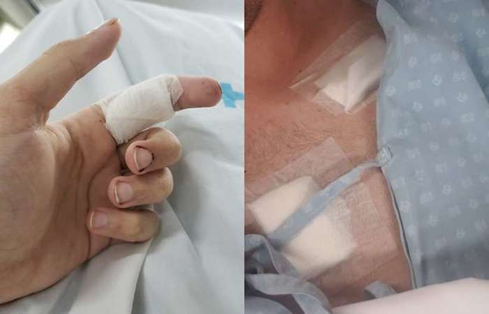 Os ferimentos só não foram mais sérias porque a faca usada no crime não estava tão afiada e Alexandre usava um colete para correção de postura. Foto: Arquivo Pessoal/Foto: Arquivo Pessoal Os ferimentos só não foram mais sérias porque a faca usada no crime não estava tão afiada e Alexandre usava um colete para correção de postura. Foto: Arquivo Pessoal/Foto: Arquivo Pessoal