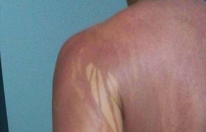 Segundo boletim m&eacute;dico do Hospital Regional Costa do Cacau, inicialmente ele teria sofrido queimaduras de primeiro grau, com quadro de escama&ccedil;&atilde;o/Foto: Arquivo Pessoal