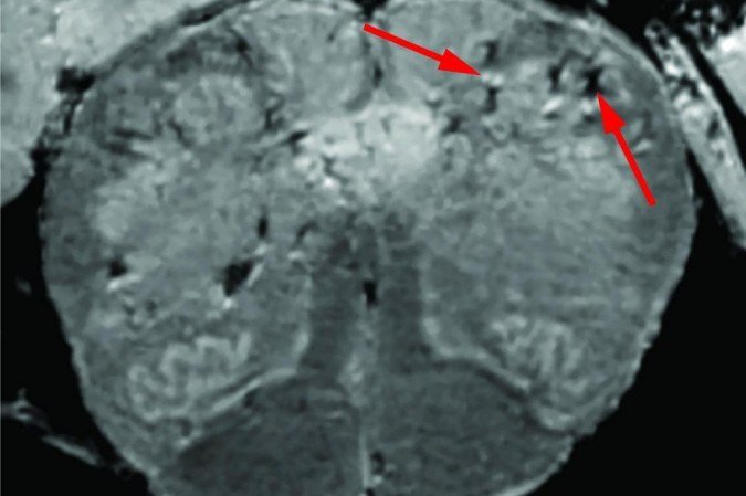 /Pontos claros e escuros marcados pelas setas demonstram os danos cerebrais em pacientes com Covid-19. Foto: NIH/NINDS/Divulgação /Pontos claros e escuros marcados pelas setas demonstram os danos cerebrais em pacientes com Covid-19. Foto: NIH/NINDS/Divulgação