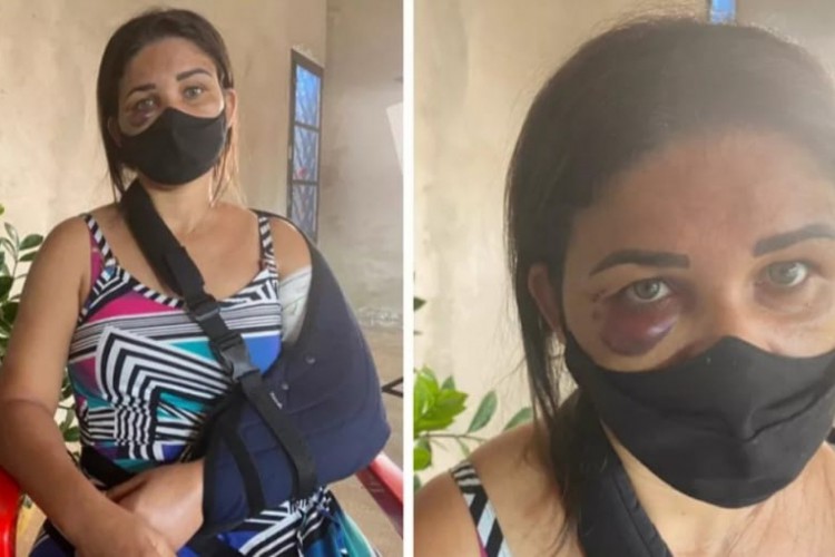 /Adriana foi submetida a uma cirurgia em função da fratura em um dos braços e recebeu alta no domingo (13). Foto: Reprodução/TV Tem