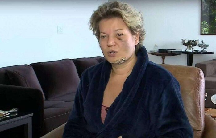 /Parlamentar acordo com o rosto cheia de fraturas, mas não sabe se caiu da cama ou foi agredida por alguém que invadiu o apartamento. Foto: Reprodução/SBT