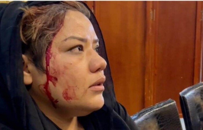 Razia Barak Haidari, 26 anos, foi socada na orelha/Foto: material cedido ao Correio Braziliense Razia Barak Haidari, 26 anos, foi socada na orelha/Foto: material cedido ao Correio Braziliense