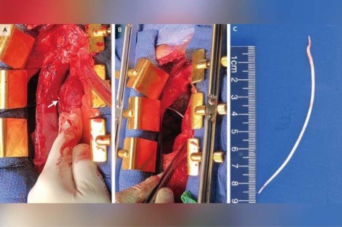 /O objeto tinha 10,1 centímetros de comprimento e já perfurava o coração e o pulmão do paciente, além de obstruir a passagem de sangue nas veias. Foto: The New England Journal of Medicine
