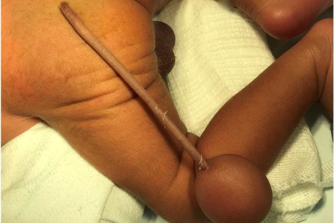 /Em toda a literatura mundial, somente 40 casos do tipo foram relatados: a identificação em uma publicação de tamanha importância de um caso no Brasil ajuda a levantar mais conhecimentos. Foto: Reprodução/Journal of Pediatric Surgery Case Reports /Em toda a literatura mundial, somente 40 casos do tipo foram relatados: a identificação em uma publicação de tamanha importância de um caso no Brasil ajuda a levantar mais conhecimentos. Foto: Reprodução/Journal of Pediatric Surgery Case Reports