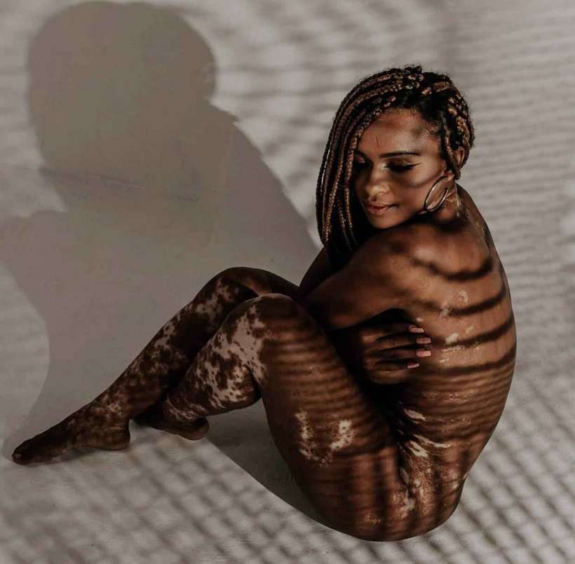/Modelo descobriu aos 9 anos a doença que, hoje, encara de peito aberto: 'É assim que as pessoas vão ter que me respeitar'. Foto: Reprodução/Instagram /Modelo descobriu aos 9 anos a doença que, hoje, encara de peito aberto: 'É assim que as pessoas vão ter que me respeitar'. Foto: Reprodução/Instagram
