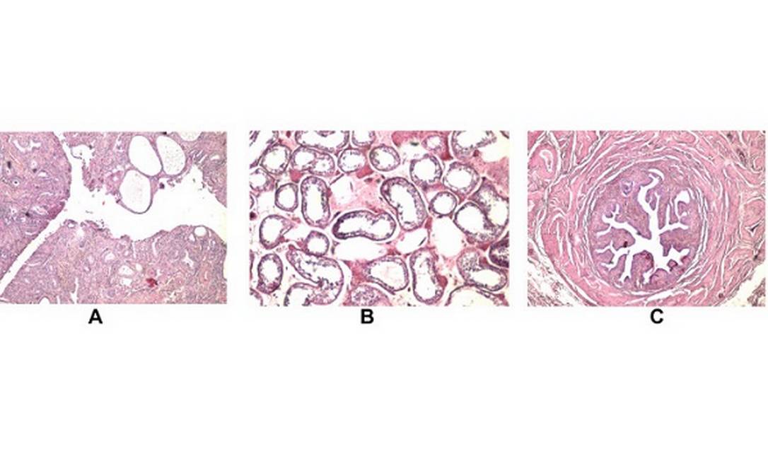 &Uacute;tero e endom&eacute;trio (A); Tuba e epid&iacute;dimo (B) e test&iacute;culo (C) descobertos em paciente durante cirugia de h&eacute;rnia/Foto: Reprodu&ccedil;&atilde;o/Urology Case Reports