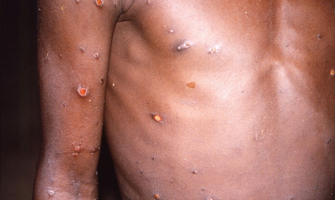 /Estudo indica que vírus pertence à região da África Ocidental. Foto: CDC/Brian W.J.Mahy /Estudo indica que vírus pertence à região da África Ocidental. Foto: CDC/Brian W.J.Mahy