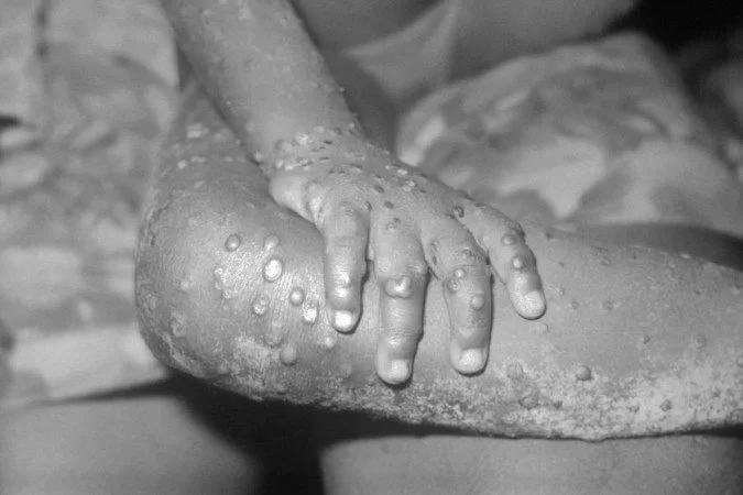 /Foto: CDC. /Foto: CDC.