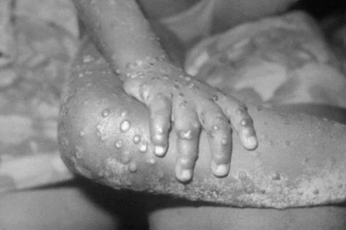 /Foto: Reprodução/CDC /Foto: Reprodução/CDC