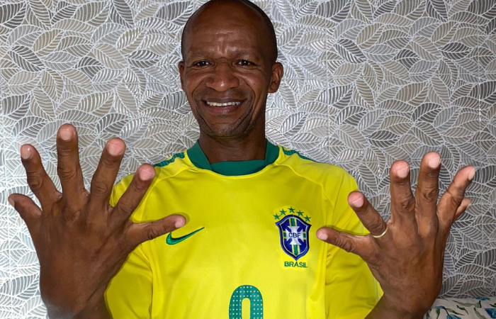 Presidente eleito compartilhou notícia do baiano que tem seis dedos na mão/Crédito: Reprodução/Arquivo Pessoal Presidente eleito compartilhou notícia do baiano que tem seis dedos na mão/Crédito: Reprodução/Arquivo Pessoal