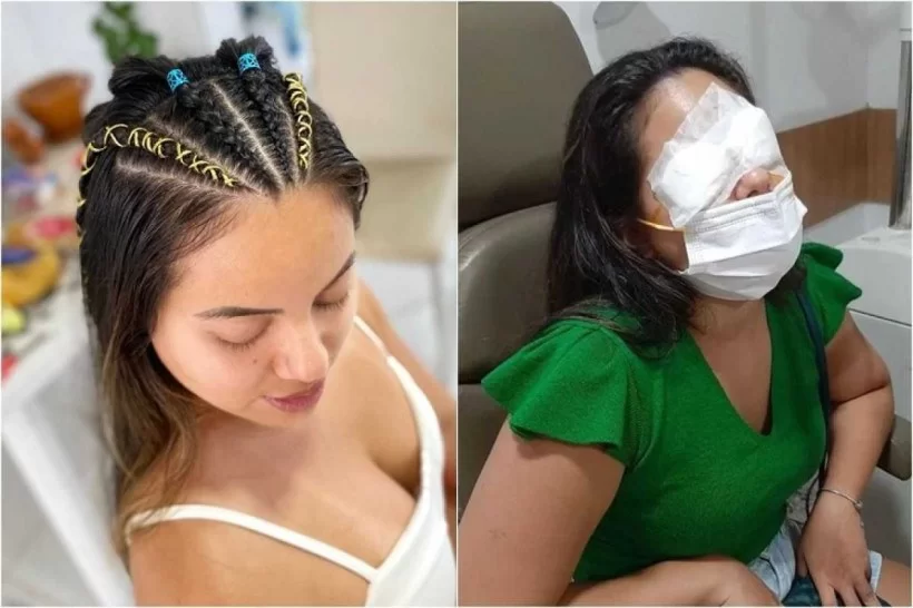 Pomada modeladora de trança causa cegueira temporária em foliões de PE -