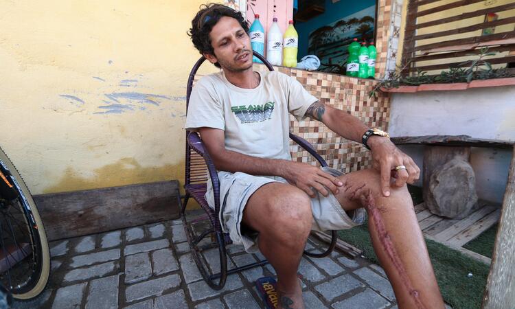 André Sthwart  Luiz Gomes da Silva, de 33 anos, é pai de 5 filhos e está desempregado e sem poder trabalhar por causa das sequelas que a mordida deixou em sua perna esquerda/Foto: Ruan Pablo/DP Foto