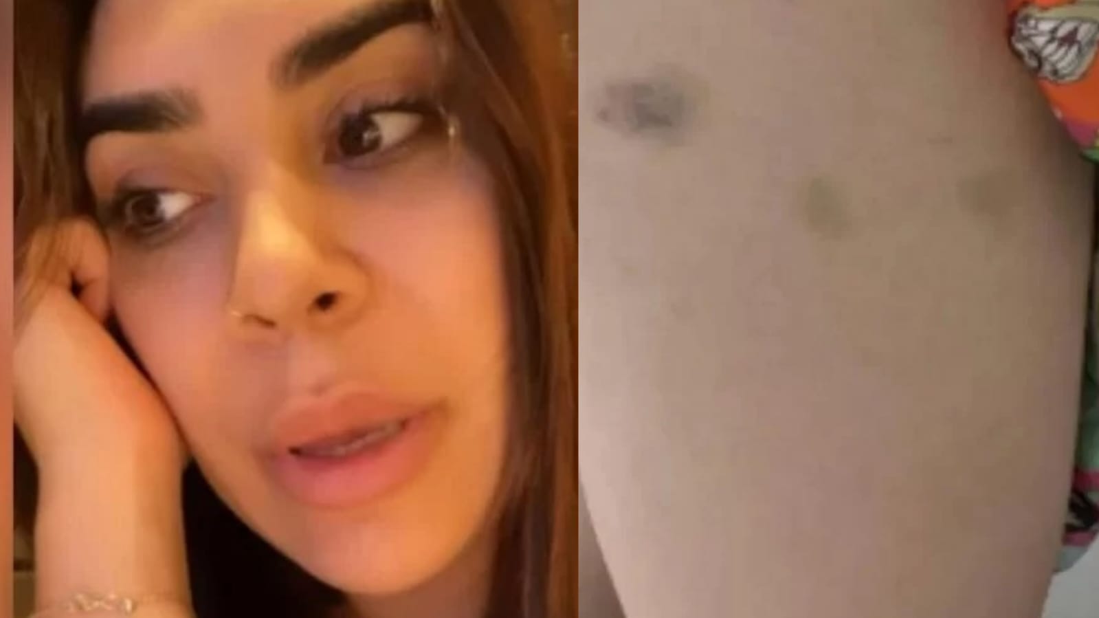 Naiara Azevedo anexou imagens de vários hematomas pelo corpo/foto: Reprodução Naiara Azevedo anexou imagens de vários hematomas pelo corpo/foto: Reprodução