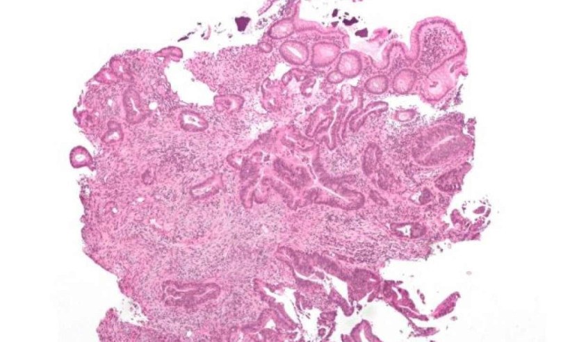 Adenocarcinoma invasivo, o tipo mais comum de cancro colorretal/foto: Nephron/Wikimedia Commons Adenocarcinoma invasivo, o tipo mais comum de cancro colorretal/foto: Nephron/Wikimedia Commons