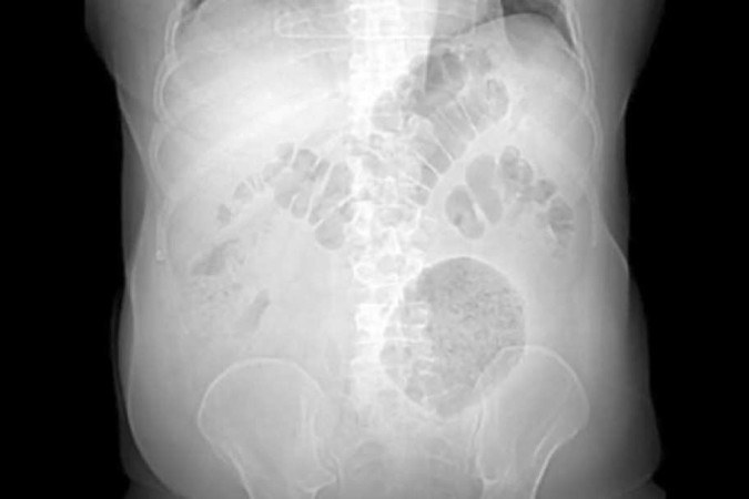A doença raríssima é uma formação inflamatória de 13 x 12 x 10cm na região abdominal/foto: Divulgação/Secretaria Municipal de Saúde do Rio de Janeiro A doença raríssima é uma formação inflamatória de 13 x 12 x 10cm na região abdominal/foto: Divulgação/Secretaria Municipal de Saúde do Rio de Janeiro