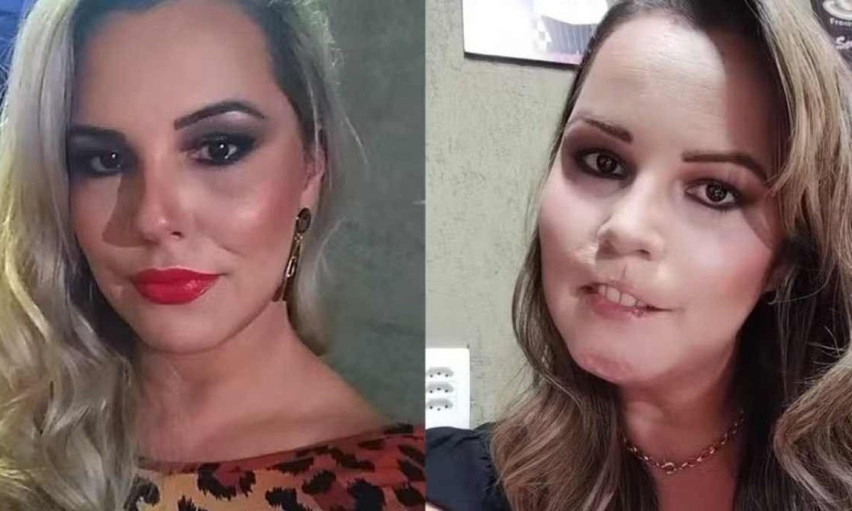 Depois de voltar na profissional que realizou o preenchimento, Mariana recorreu a uma consulta com uma dermatologista que receitou um tratamento com antibióticos e corticoides, que não tiveram efeito/foto: Redes Sociais/ Reprodução Depois de voltar na profissional que realizou o preenchimento, Mariana recorreu a uma consulta com uma dermatologista que receitou um tratamento com antibióticos e corticoides, que não tiveram efeito/foto: Redes Sociais/ Reprodução