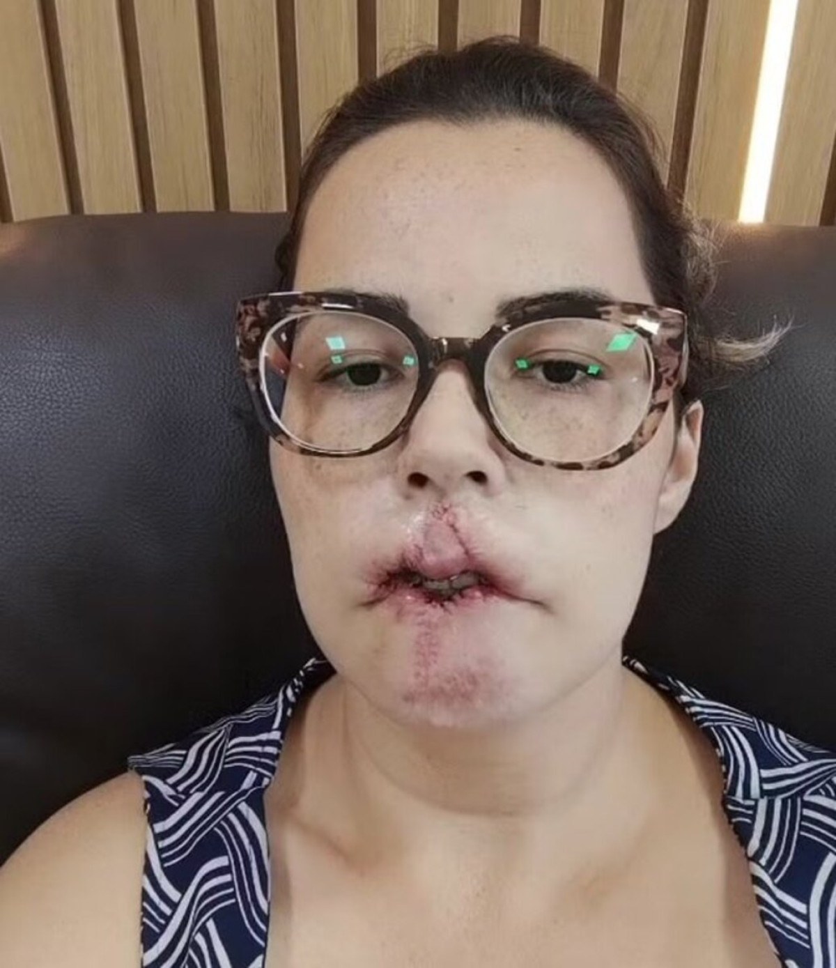 Seis meses depois do procedimento, Mariana acordou com o rosto muito inchado e dolorido