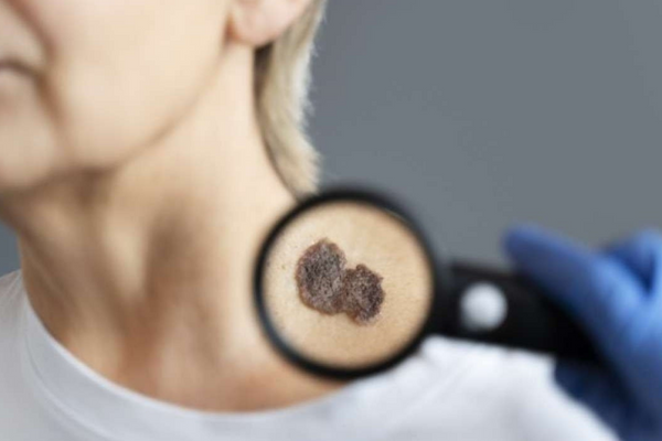 Os melanomas podem ser na cor marrom, irregulares ou planos, e caroços pretos ou cinzentos/Crédito: Freepik/Divulgação Os melanomas podem ser na cor marrom, irregulares ou planos, e caroços pretos ou cinzentos/Crédito: Freepik/Divulgação