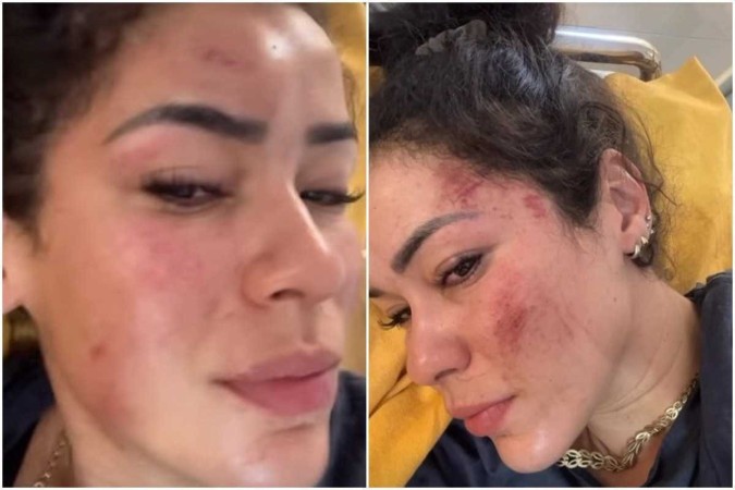 Fernanda: ''Meu rosto está assim, mas não é o que mais me dói''/Crédito: Reprodução Istagram Fernanda: ''Meu rosto está assim, mas não é o que mais me dói''/Crédito: Reprodução Istagram