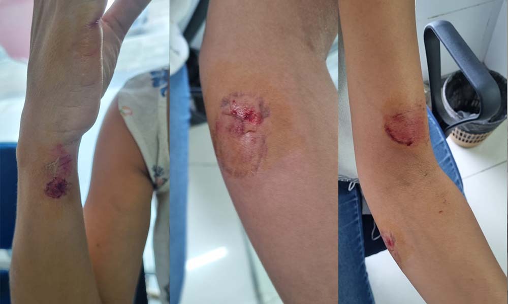 A mulher foi atacada pelo ex-companheiro com golpes de faca e ainda foi lesionada com mordidas, em seu apartamento, no bairro de Candeias, em Jaboatão dos Guararapes/Foto: Reprodução/Redes Sociais A mulher foi atacada pelo ex-companheiro com golpes de faca e ainda foi lesionada com mordidas, em seu apartamento, no bairro de Candeias, em Jaboatão dos Guararapes/Foto: Reprodução/Redes Sociais