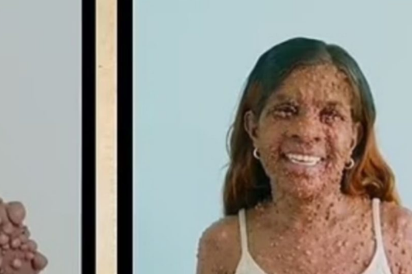 Charmaine Sahadeo, mulher com nuerofibromatose e centenas de tumores no corpo/Crédito: Reprodução/Facebook Charmaine Sahadeo, mulher com nuerofibromatose e centenas de tumores no corpo/Crédito: Reprodução/Facebook