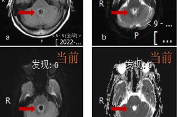 Estudos médicos sobre infecções intracranianas por B. mandrillaris, revelam apenas 10 sobreviventes entre mais de 150 casos relatados em todo o mundo/foto: Reprodução/Revista Científica Heliyon Estudos médicos sobre infecções intracranianas por B. mandrillaris, revelam apenas 10 sobreviventes entre mais de 150 casos relatados em todo o mundo/foto: Reprodução/Revista Científica Heliyon