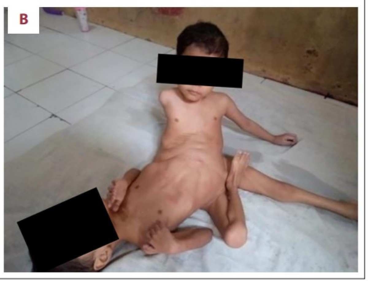 Um dos objetivos da cirurgia era ajudar os gêmeos a conseguir ficar sentados