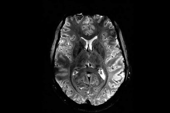 A ressonância permite visualizar alterações no padrão da conexão entre células e redes cerebrais/foto: CEA/Divulgação A ressonância permite visualizar alterações no padrão da conexão entre células e redes cerebrais/foto: CEA/Divulgação