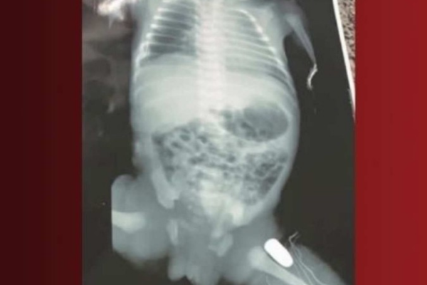 A cirurgia na bebê foi realizada após a mãe ser submetida a uma cesárea/Crédito: Reprodução/Bom dia