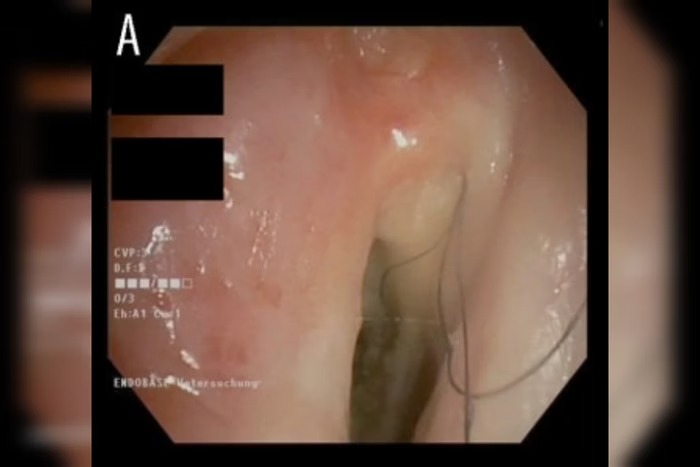 Homem de 52 anos teve complicação rara do uso de cigarro que fez cabelos crescerem até 5 centímetros por ano em sua garganta/foto: Reprodução/ American Journal of Case Reports Homem de 52 anos teve complicação rara do uso de cigarro que fez cabelos crescerem até 5 centímetros por ano em sua garganta/foto: Reprodução/ American Journal of Case Reports
