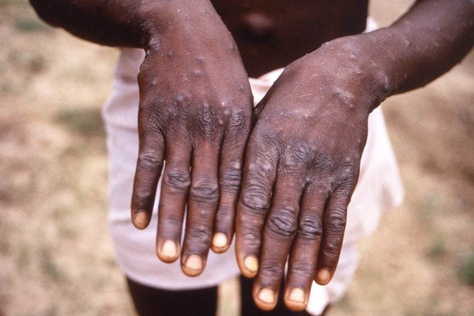 A Organização Mundial da Saúde (OMS) alertou nesta quinta-feira (11) para a ameaça representada pela mpox/foto: AFP A Organização Mundial da Saúde (OMS) alertou nesta quinta-feira (11) para a ameaça representada pela mpox/foto: AFP