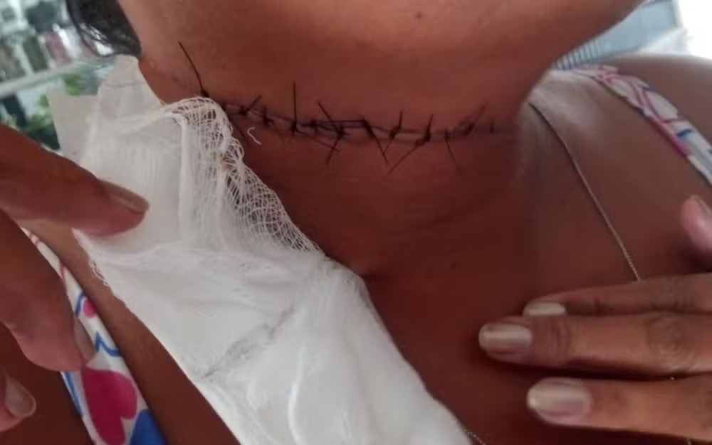 A vítima, após ser esfaqueada, foi socorrida por vizinhos para a Unidade de Pronto Atendimento (UPA) de Paulista, em que já teve alta após levar pontos no pescoço devido aos ferimentos causados pela facada/Foto: Reprodução/Redes Sociais