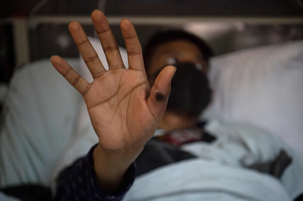 De acordo CDC África, desde janeiro de 2022 já foram registrados 38.465 casos em 16 países africanos, com 1.456 mortes/foto: Ernesto Benavides/AFP De acordo CDC África, desde janeiro de 2022 já foram registrados 38.465 casos em 16 países africanos, com 1.456 mortes/foto: Ernesto Benavides/AFP