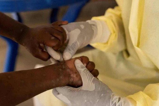 Agência da ONU para migrações pede US$ 18,5 bi para combater mpox/foto: EBC Agência da ONU para migrações pede US$ 18,5 bi para combater mpox/foto: EBC