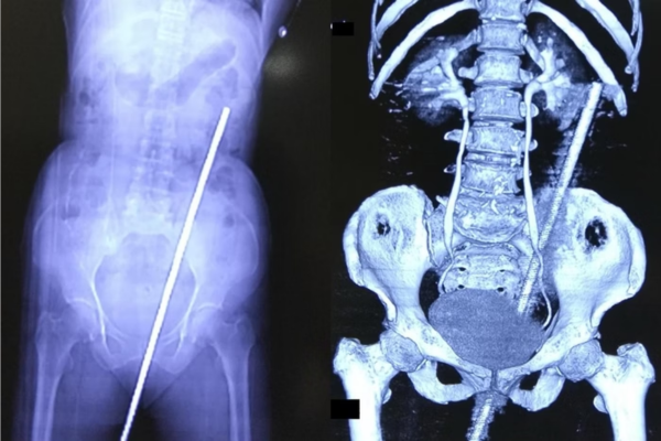 Raio x de uma mulher que ficou empalada em ferro de 60 cm após cair no chão do quintal/Crédito: International Journal of Surgery Case Reports Raio x de uma mulher que ficou empalada em ferro de 60 cm após cair no chão do quintal/Crédito: International Journal of Surgery Case Reports