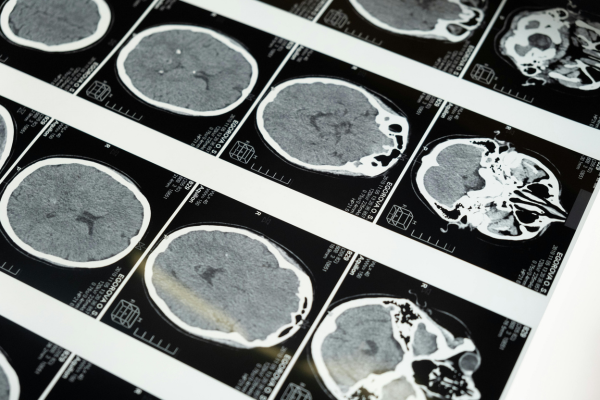 Pesquisadores analisaram imagens de alta resolução do tronco cerebral de 31 pacientes/Crédito: Pexels Pesquisadores analisaram imagens de alta resolução do tronco cerebral de 31 pacientes/Crédito: Pexels