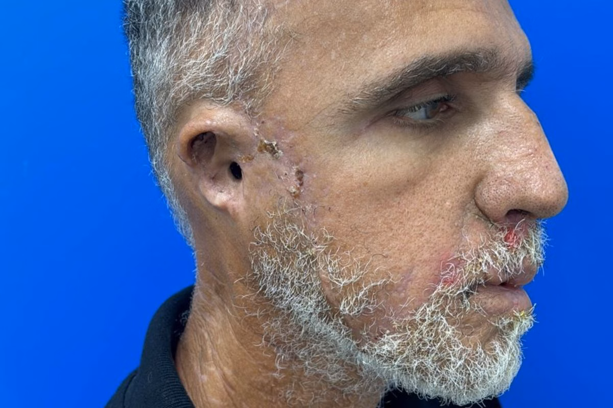 Wagner teve diversos traumas na face, com deslocamento de pele